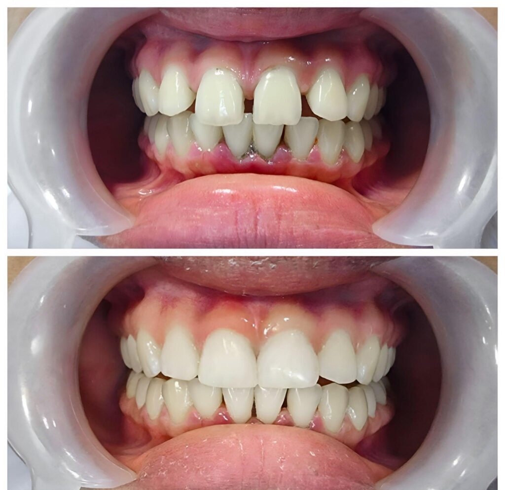 Understanding Dental Bonding: What It Is, When It's Needed, and How Long Does Dental Bonding Last?