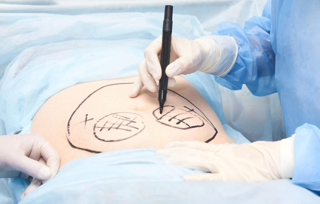 Does Insurance Cover Liposuction for Lipedema? Understanding Your Insurance Coverage